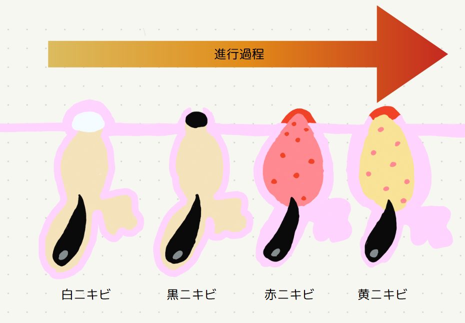 ニキビができるステップ